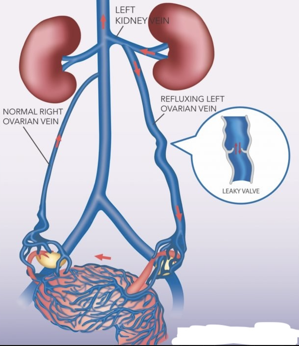 Pelvic vein anatomy showing congested veins